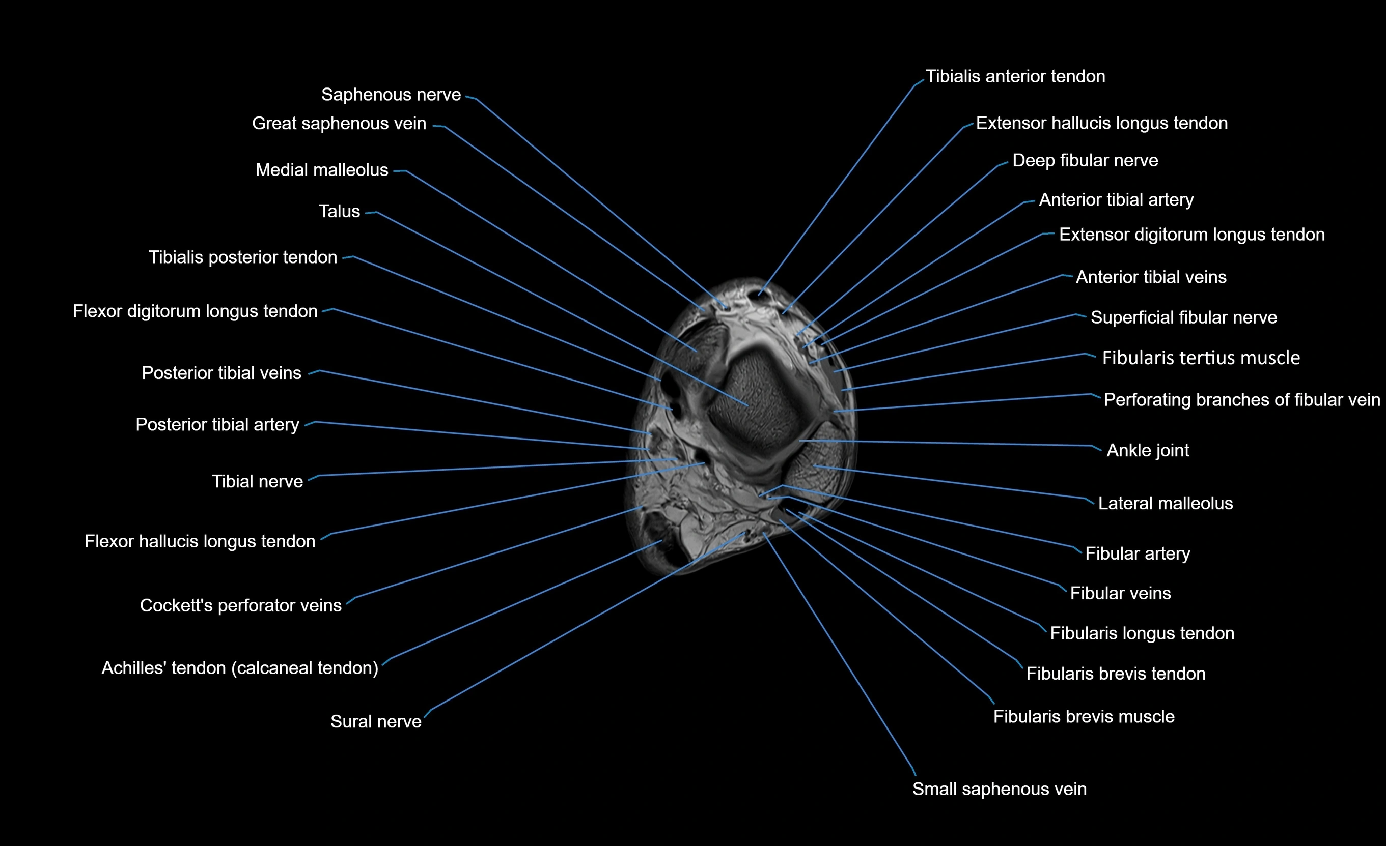 MRI lower leg axial cross sectional anatomy 3T  radiology  image-img-00001-00101.webp